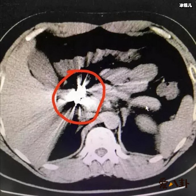 男生为何赌气吃一条金项链 得知什么原因竟然让医生崩溃?