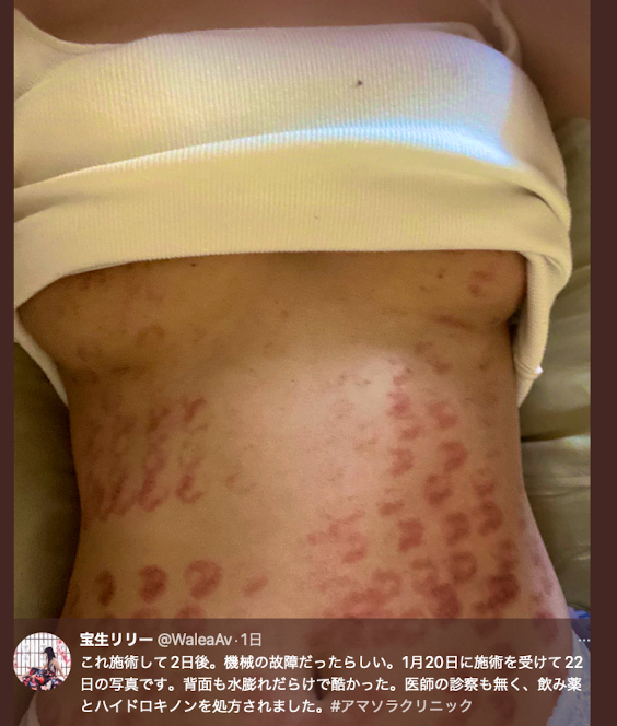 除毛搞得一身伤!宝生リリー(宝生莉莉)恐生涯终结!