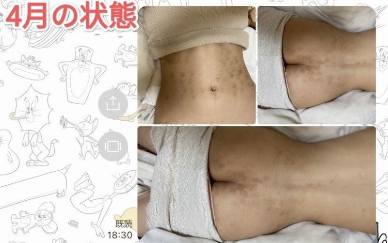 除毛搞得一身伤!宝生リリー(宝生莉莉)恐生涯终结!